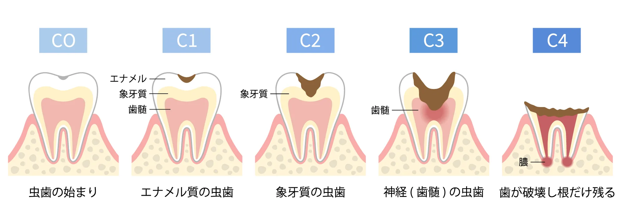 虫歯の進行イメージ