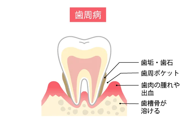 歯周病イメージ